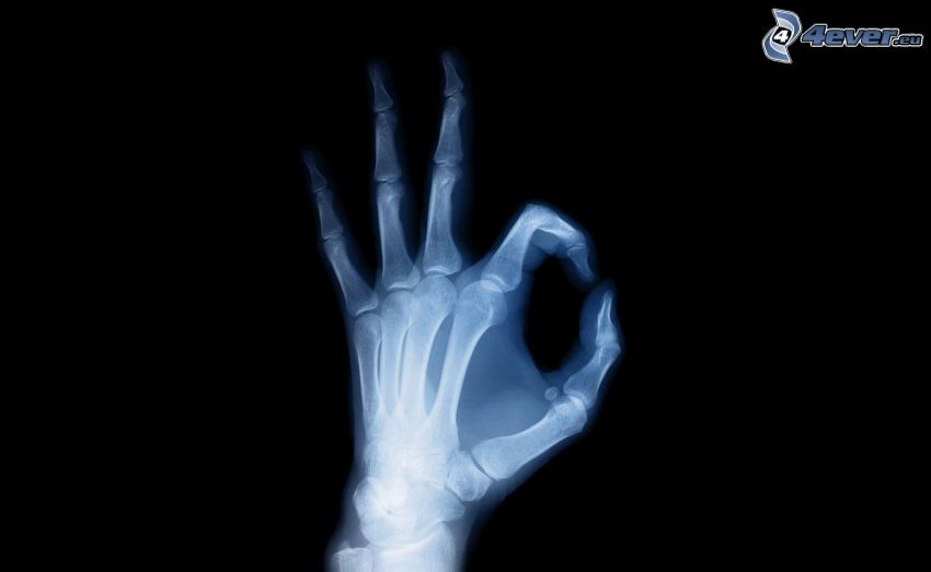 ręka, kości, zdjęcie rentgenowskie