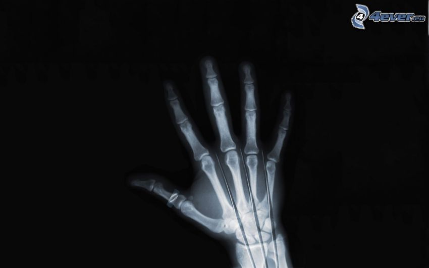 Wolverine, ręka, zdjęcie rentgenowskie