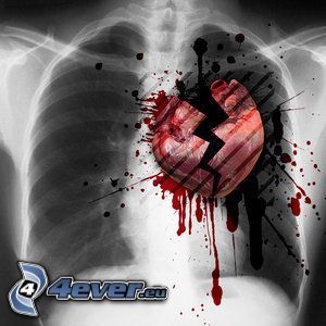 złamane serce, zdjęcie rentgenowskie, klatka piersiowa, żeberka, krew